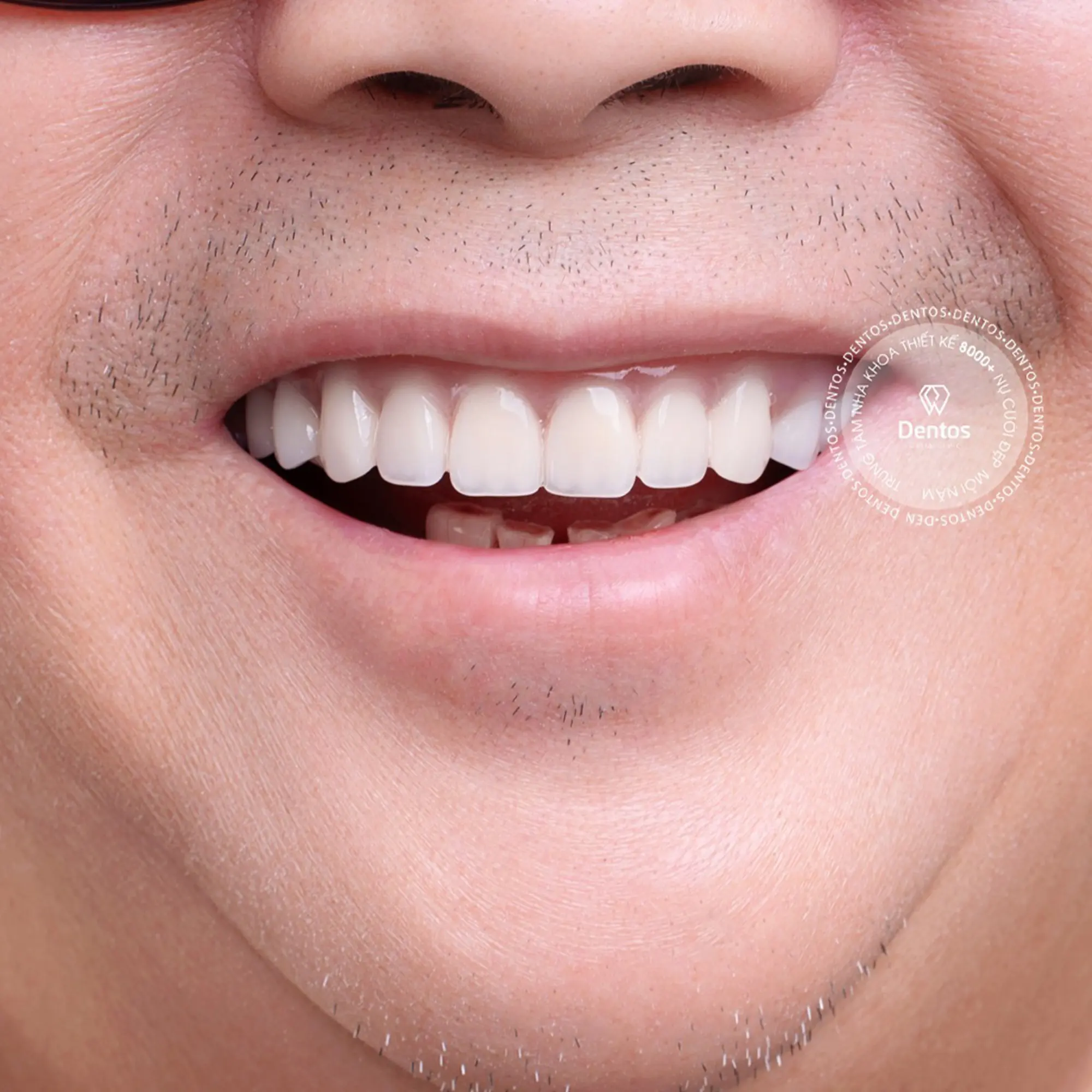 Hàm răng sau khi đã phục hình mão sứ hoàn thiện